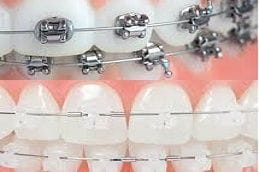 Damon Braces System in Abu Dubai Damon Braces System in Abu Dubai