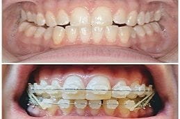 Damon Braces System in Dubai and Abu Dhabi Damon Braces System in Dubai and Abu Dhabi