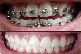 Damon Braces System in Dubai Damon Braces System in Dubai