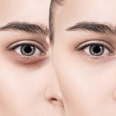 Dark Circles No More: The Definitive Guide 1 Dark Circles Treatment