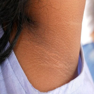 Dark Neck Whitening Treatment ,Causes , Cost 1 Dark Neck Whitening Treatment CosT