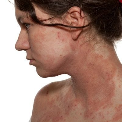 Dealing With The Discomfort of Eczema In Dubai 1 Dealing With The Discomfort of Eczema In Dubai UAE