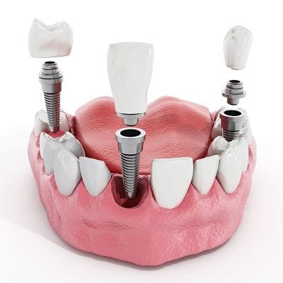 Dental Implant Clinic