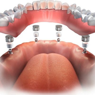 Dental Implant Procedure: Step-By-Step 1 Dental Implant Procedure: Step-By-Step