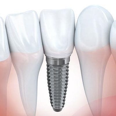 Dental Implants with Gum Diseases 1 Dental Implants with Gum Diseases