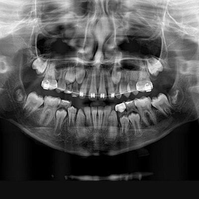 Dental Panoramic X-Ray Costs in Dubai