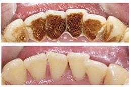 Dental Stain Removal 1 Dental Stains Removal in Dubai