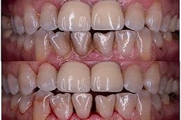 Dental Tooth Calculus 1 Dental Tooth Calculus in Abu Dhabi