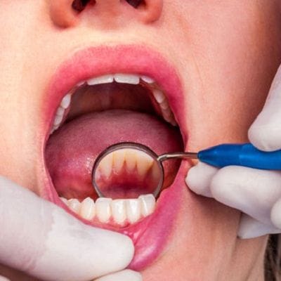 Dental Tooth Calculus in Dubai & Abu Dhabi Teeth Tartar Cost