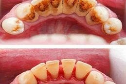 Dental Tooth Calculus 2 Dental Tooth Calculus in Dubai & Abu Dhabi