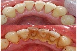 Dental Tooth Calculus 3 Dental Tooth Calculus in Dubai
