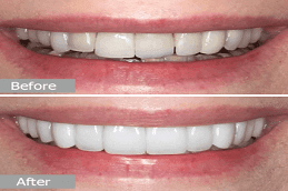 Dental Veneers Dubai 4 Dental Veneers