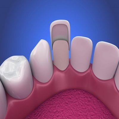 Dental Veneers in Dubai Abu Dhabi