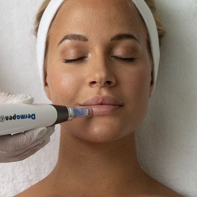 Dermapen Treatment for Minimising Pores 1 Dermapen Treatment for Minimising Pores