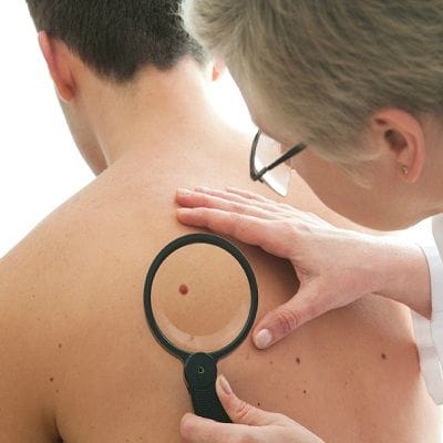 Dermoscopy Mole Evaluation in Dubai