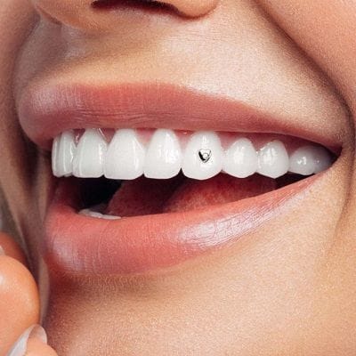 Diamond Teeth in Dubai & Abu Dhabi
