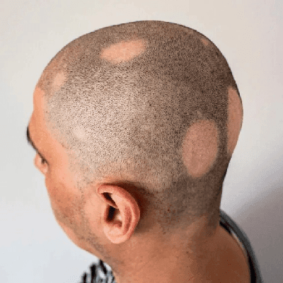 Difference Between Non-Scarring and Scarring Alopecia 1 Difference Between Non-Scarring and Scarring Alopecia