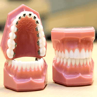 Do Lingual Braces Take Longer in Dubai
