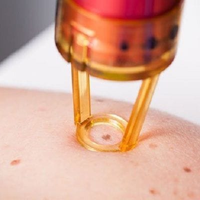 Does Laser Mole Removal Leave a Scar