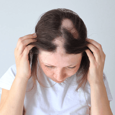 Does Saxenda Cause Hair Loss?