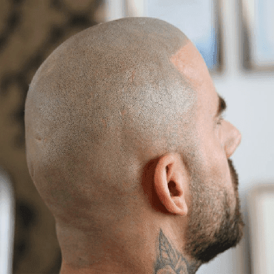 Does Scalp Micropigmentation Hurt?