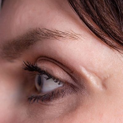 Don't let Keloid Scars Ruin your Skin or your Self-Esteem