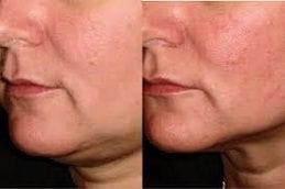 Double Chin Liposuction 5 double-chin-liposuction Clinic in Dubai
