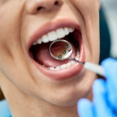 Dubais Best Kept Secret to a Hollywood Smile Lingual Braces Revealed
