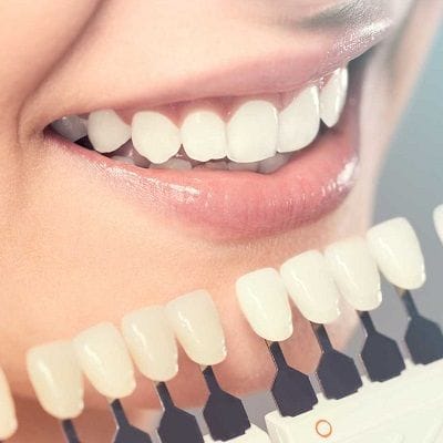 E-max veneers cost in Dubai