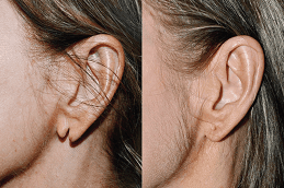 Earlobe Reduction | Earlobe Correction 4 Earlobe Correction Before and After