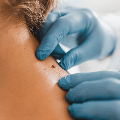 Eliminating Skin Tags with Fotona Laser Technology 1 Eliminating Skin Tags with Fotona Laser Technology