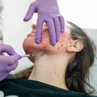 Everything About Vampire Facial Treatment