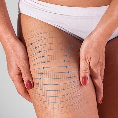 Exploring different Thigh Lift Techniques 1 Exploring different Thigh Lift Techniques