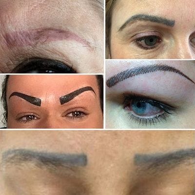 Eyebrow Tattoo Removal 1 Eyebrow Tattoo Removal