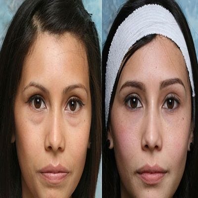 Eyelid Surgery – Eyes That Maintain That Young Look