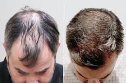 FUE Hair Transplant 4 FUE Hair Transplant Clinic in Dubai