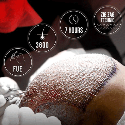FUE Hair Transplant in Dubai, Abu Dhabi & Sharjah