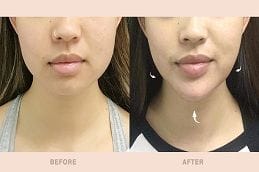 Non Surgical Face Slimming Treatments 5 Facial Slimming Treatment in Abu Dhabi