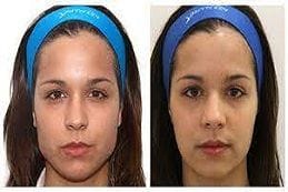 Non Surgical Face Slimming Treatments 6 Facial Slimming Treatment in Dubai