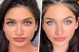Facial Slimming Treatment