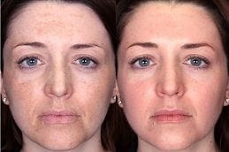 Factor Five Skin Care 4 Factor Five Serum Before and After