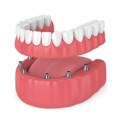 Full Mouth Dental Implants Cost 1 Full Mouth Dental Implants Cost
