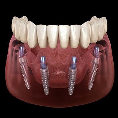 Full Mouth Rehabilitation With Dental Implants 1 Full Mouth Rehabilitation With Dental Implants