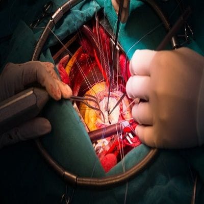 Gall Bladder Stone Treatment In Dubai