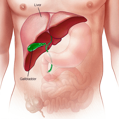 Gallbladder Stone Surgery in Dubai