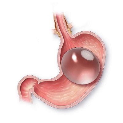 Gastric Balloon in Dubai