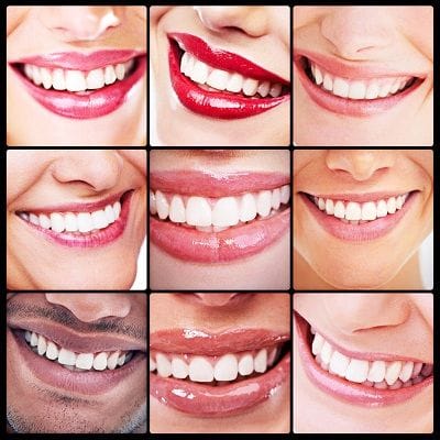 Get An Ideal Smile With Dental Veneers 1 Get An Ideal Smile With Dental Veneers