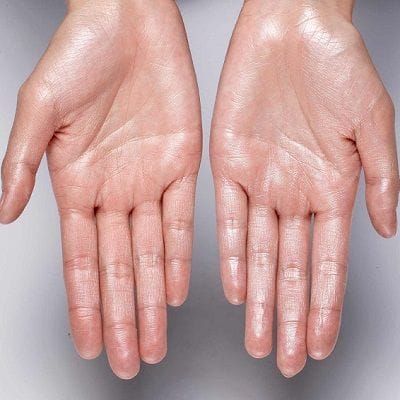 Miradry for Hands 1 Miradry for Hands