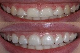 Gingivectomy Surgery in Dubai and Abu Dhabi