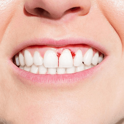 Gum Bleeding Treatment Pros and Cons in Dubai 1 Gum Bleeding Treatment Pros and Cons in Dubai
